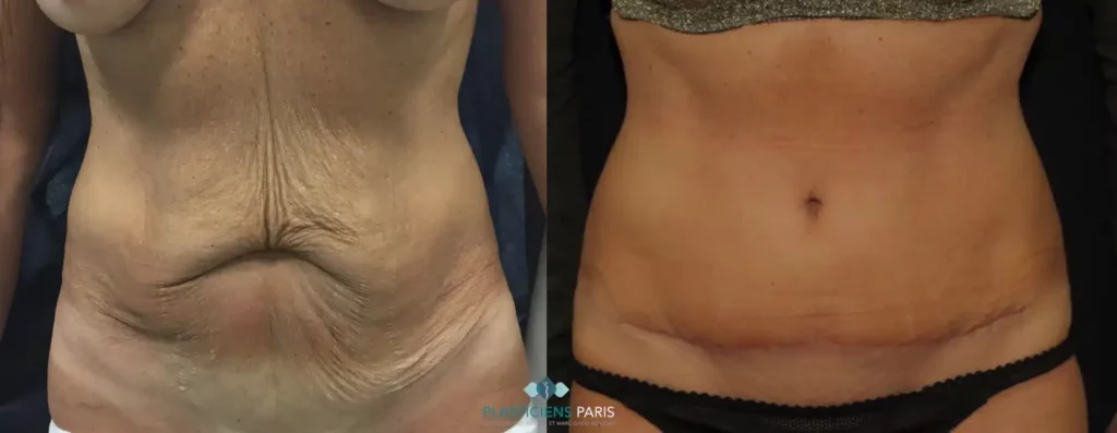 Plastie abdominale