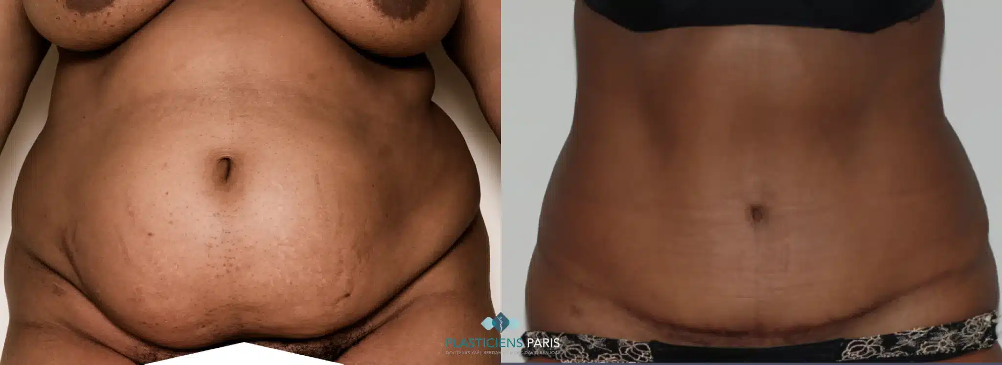 plastie abdominale