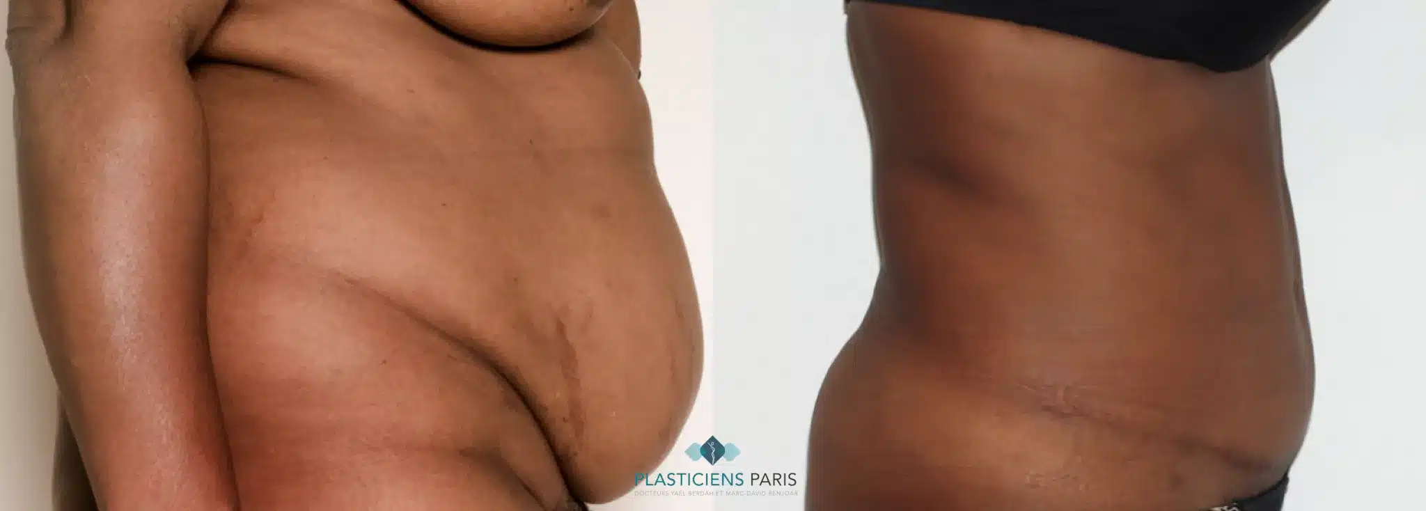 plastie abdominale