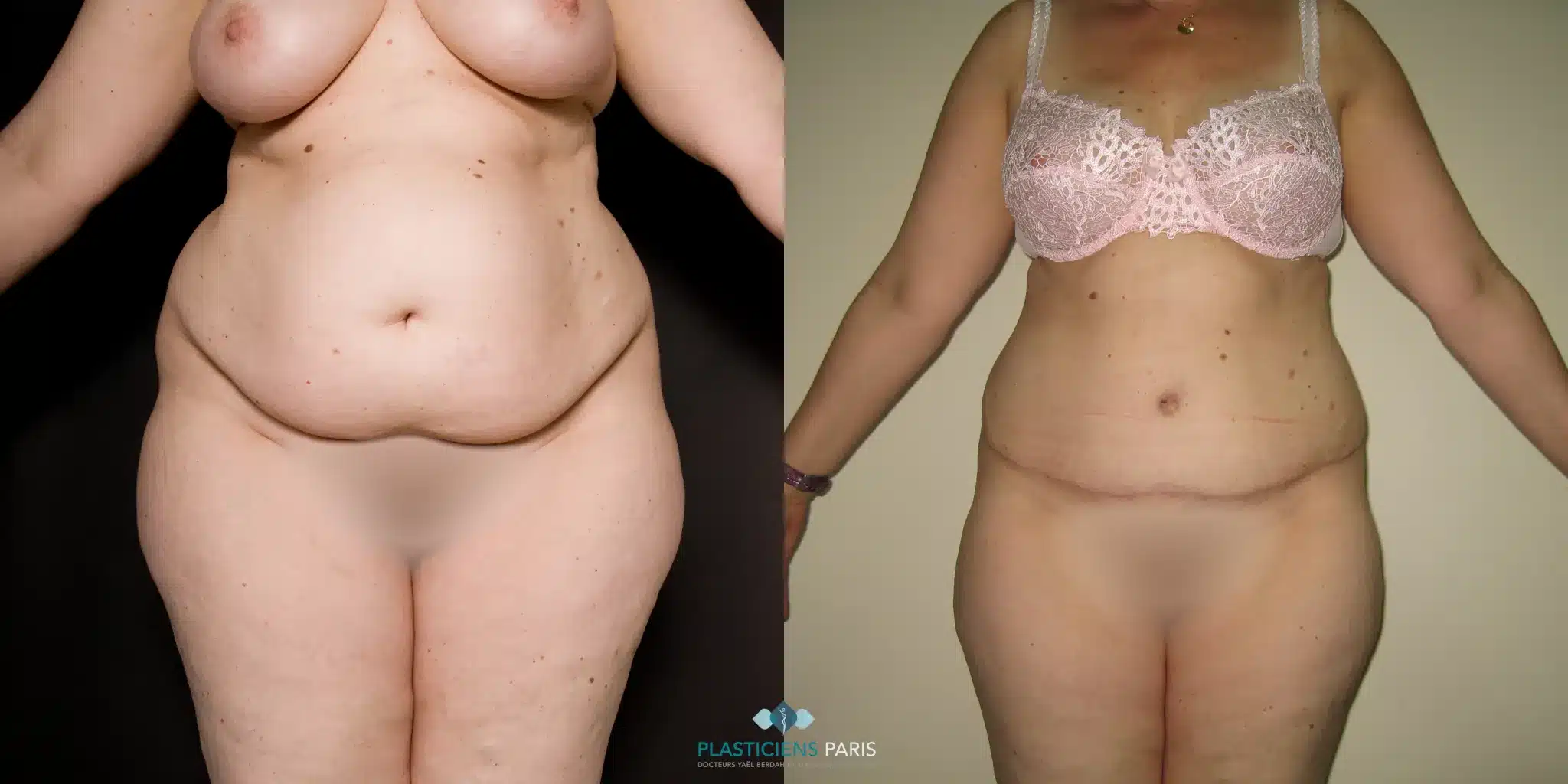 Plastie abdominale