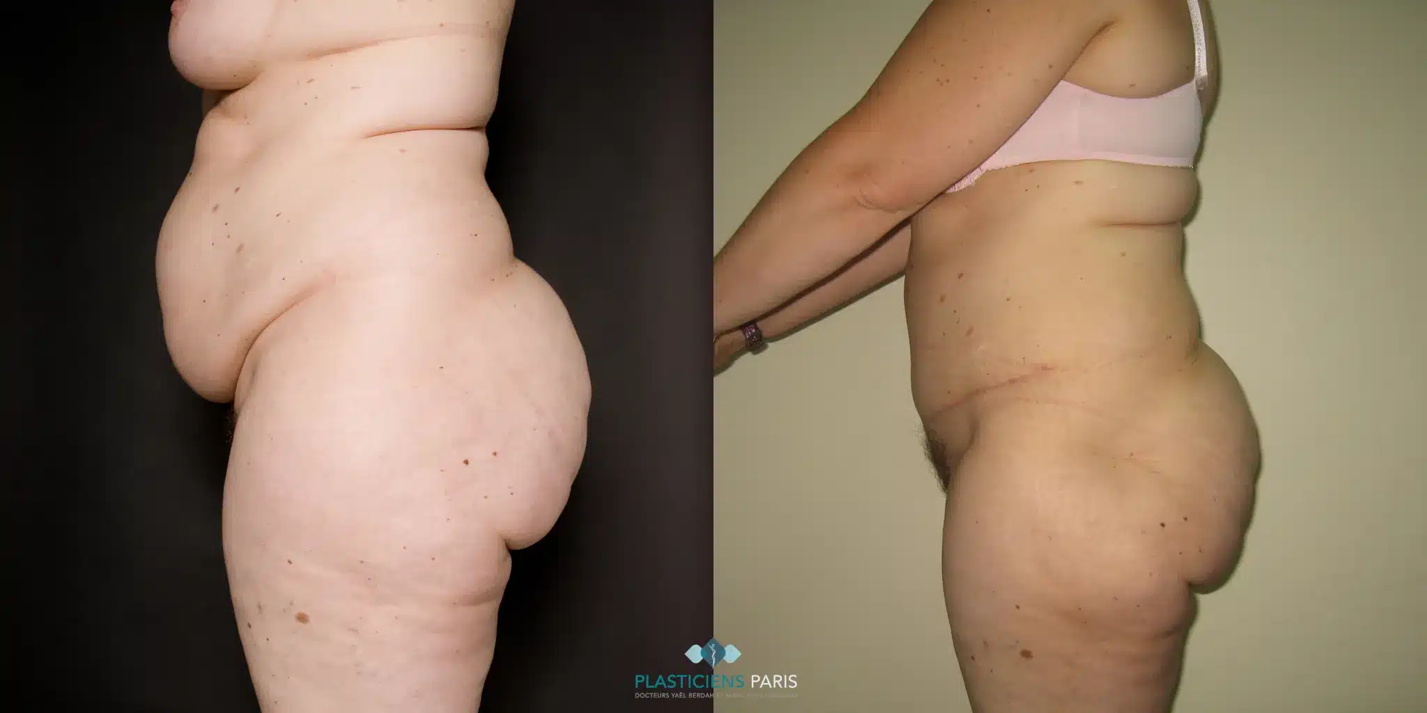 Plastie abdominale