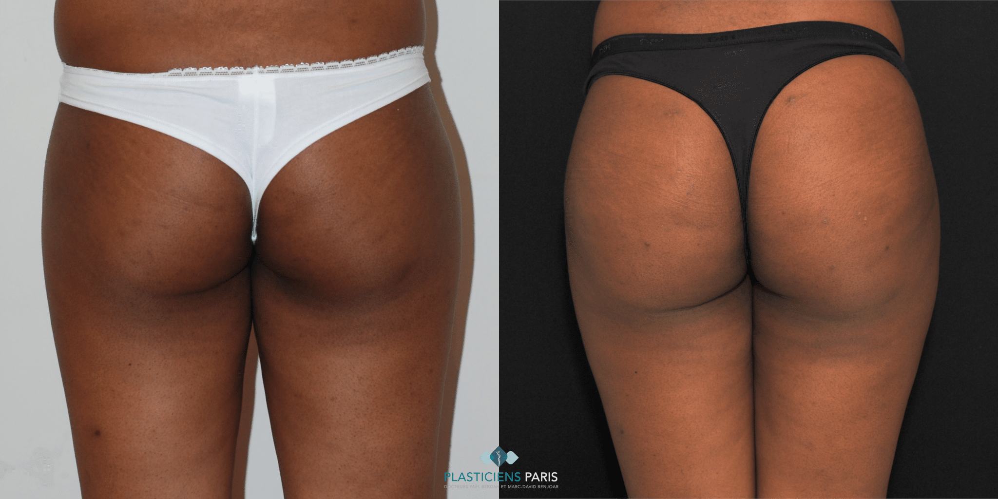protheses de fesse
