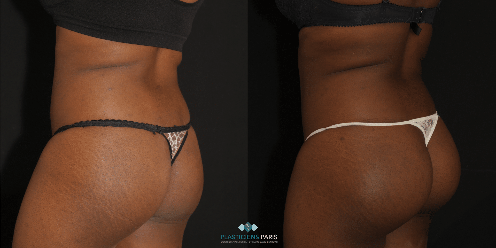 Implants fessiers