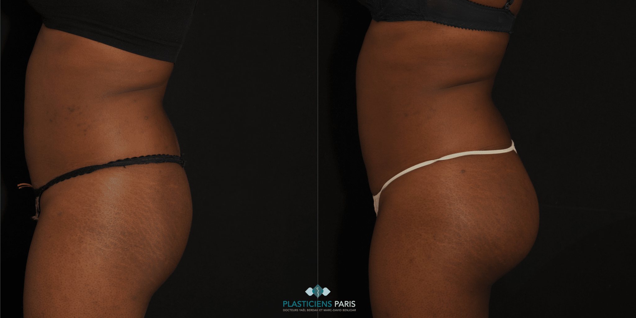Implants fessiers