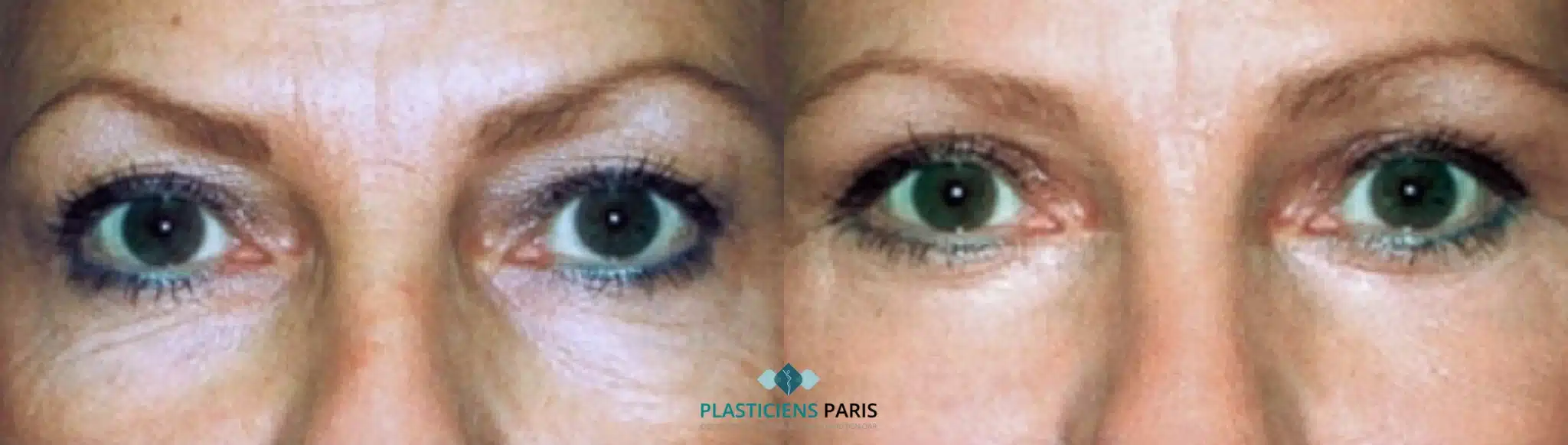 Chirurgie des paupieres