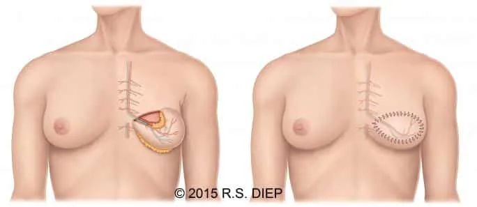 PAP