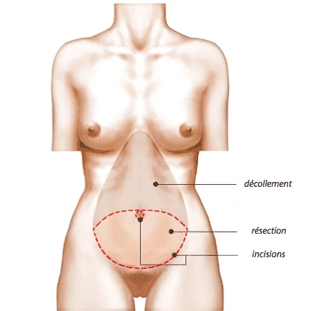 Schéma de l'abdominoplastie