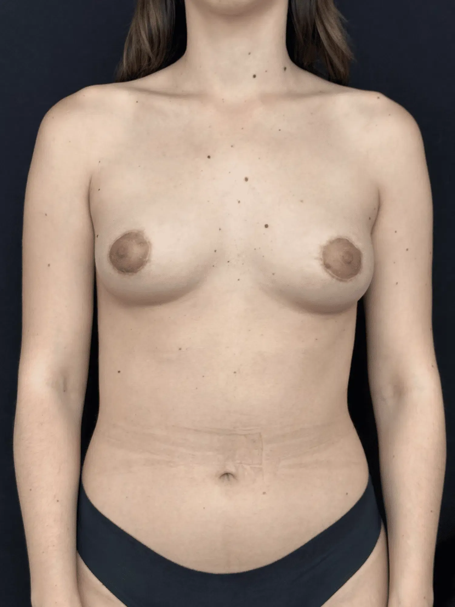 Seins tubereux Apres vue de face.png