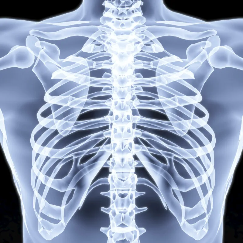 Traitement des thorax en entonnoir par prothese silicone sur mesure