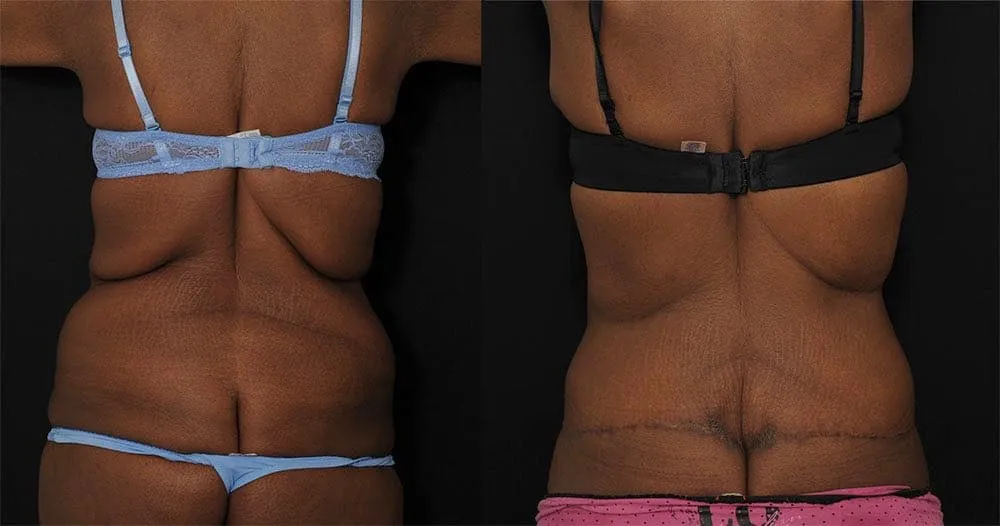bodylift