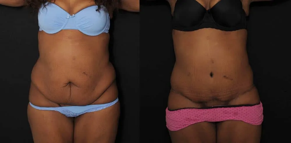 bodylift