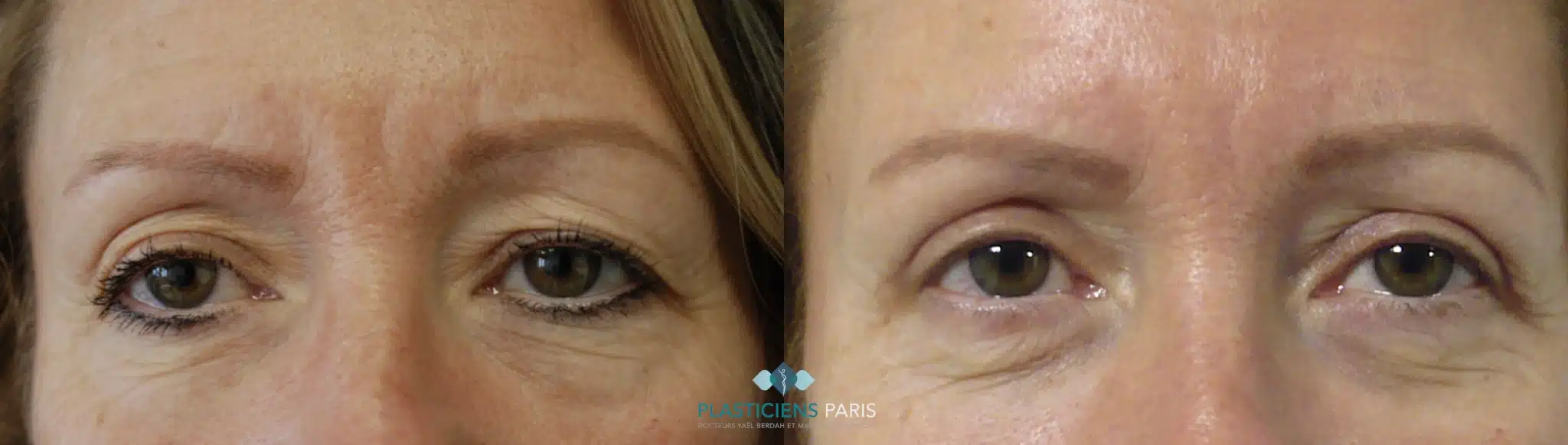 chirurgie des paupieres .png