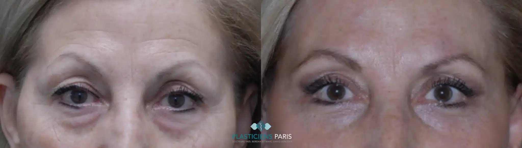 chirurgie des paupieres .png