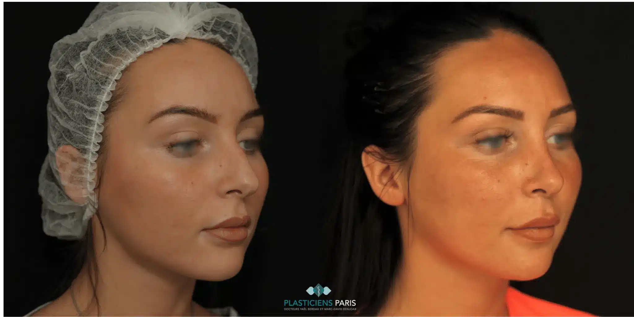 rhinoplastie