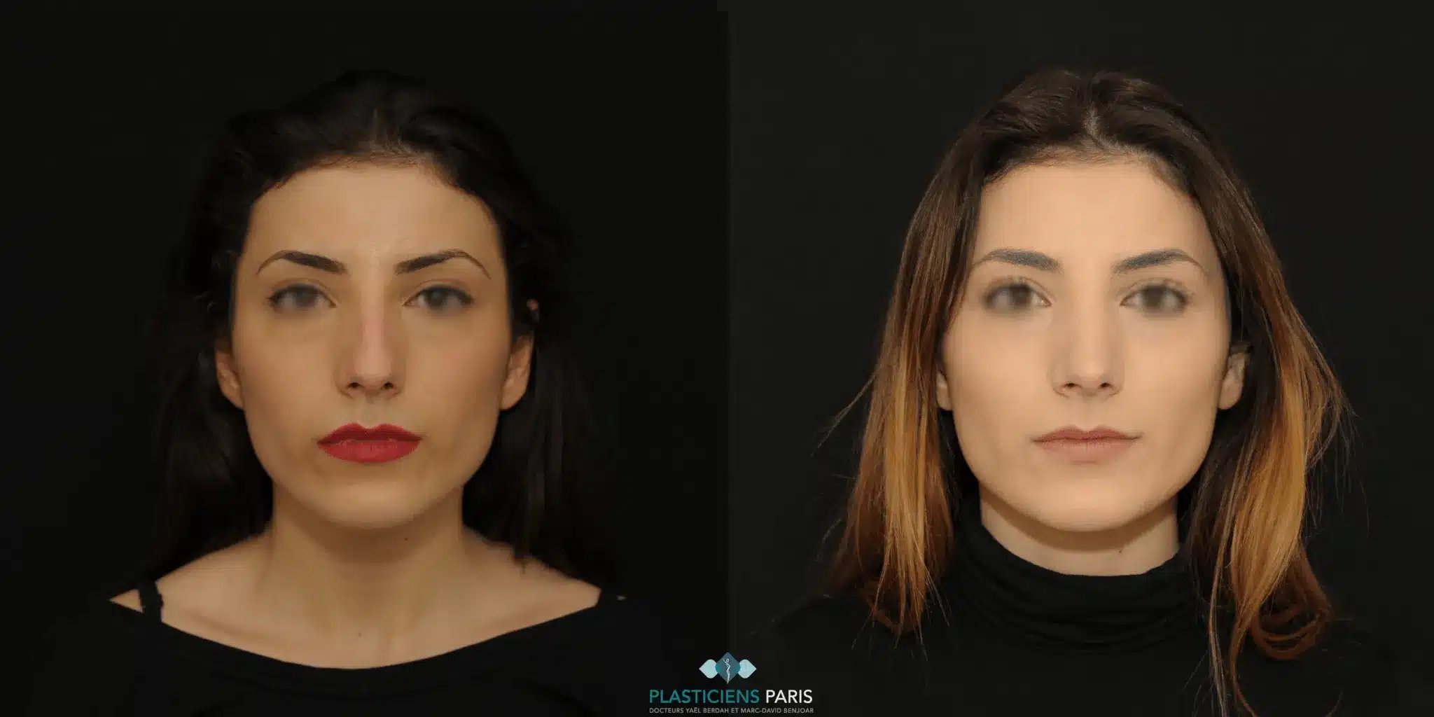 rhinoplastie