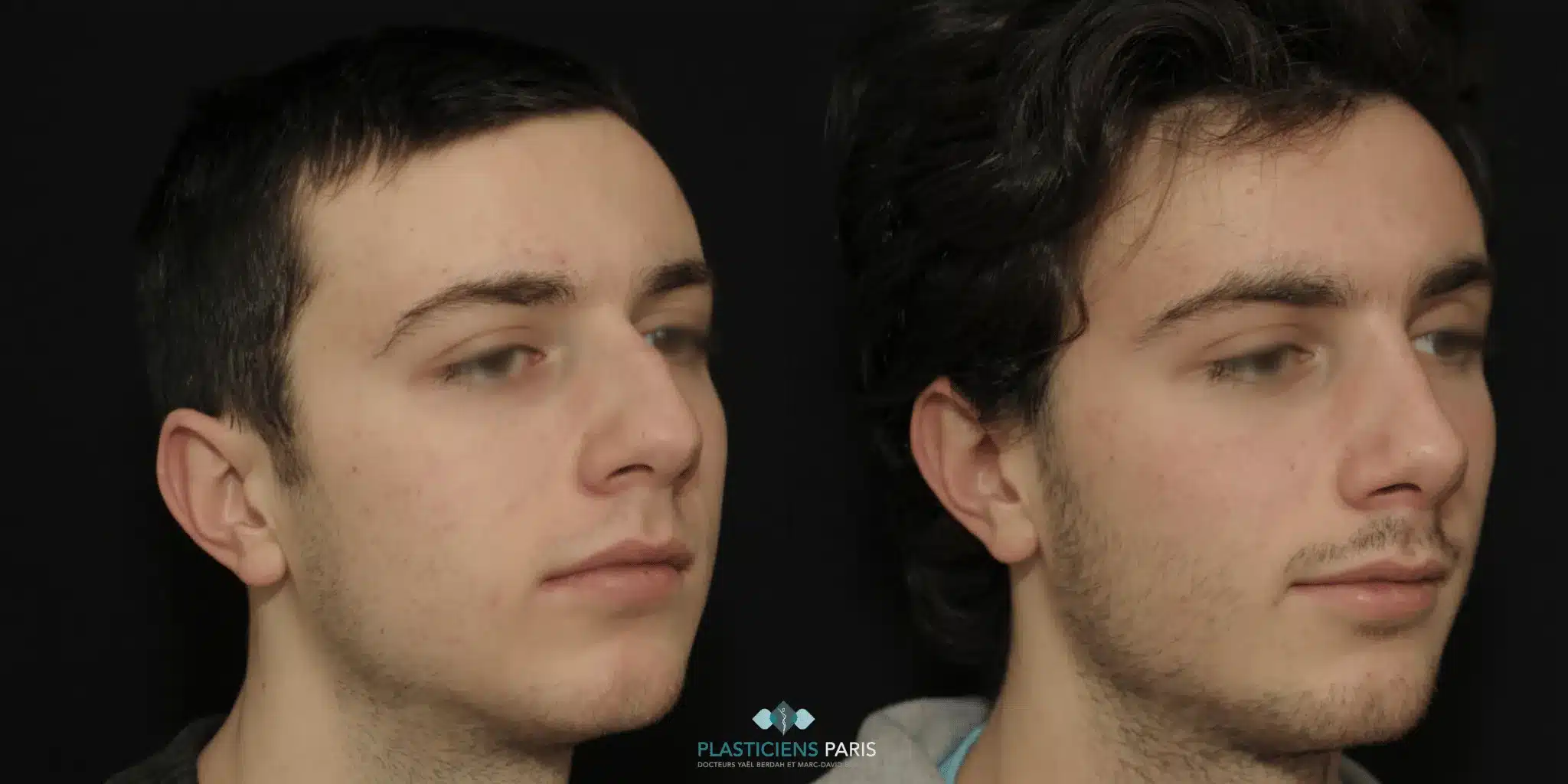 rhinoplastie